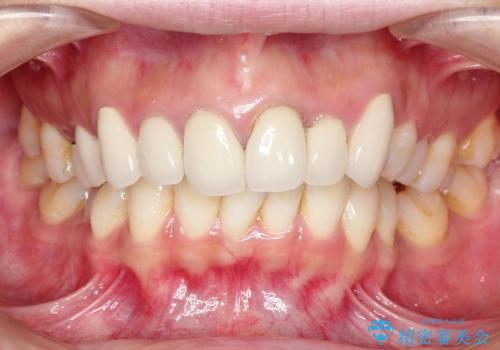 セラミック(前歯)のやり変えの症例 治療前