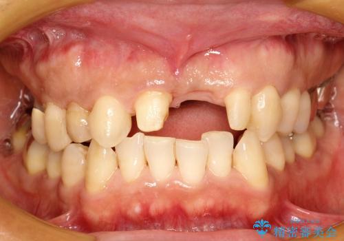40代男性　歯ぐきの厚みを増やしてブリッジの症例 治療前
