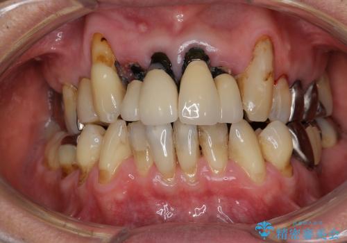重度歯周病・深い虫歯　歯を残す治療の治療前