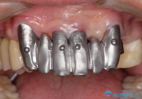 重度歯周病・深い虫歯　歯を残す治療の治療中