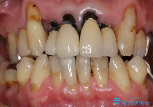 重度歯周病・深い虫歯　歯を残す治療の症例 治療前