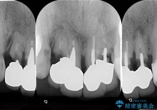 重度歯周病・深い虫歯　歯を残す治療の治療前