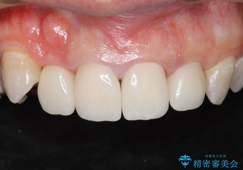 ホワイトニングと前歯のセラミック治療の治療後