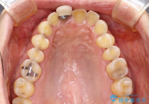 30代女性　前歯のオールセラミック+部分矯正の治療前
