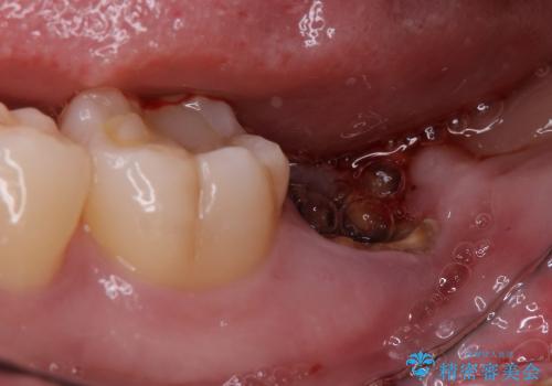 虫歯で抜歯となった左下奥歯に親知らずを自家歯牙移植した症例の治療前