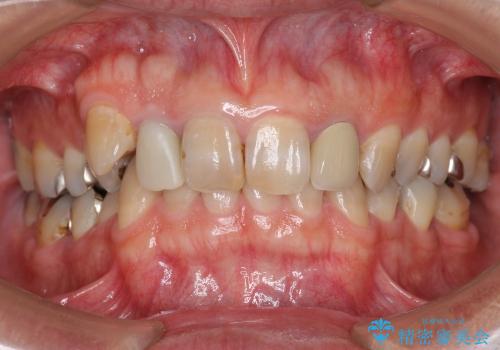 ホワイトニングと前歯のセラミック治療の症例 治療前