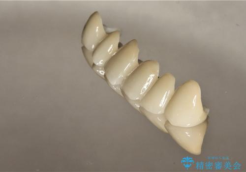 30代女性　前歯のオールセラミック+部分矯正の治療後