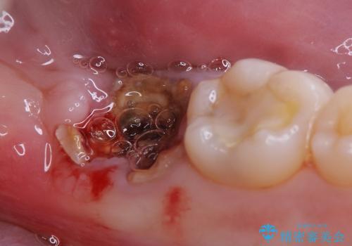 虫歯で抜歯となった左下奥歯に親知らずを自家歯牙移植した症例