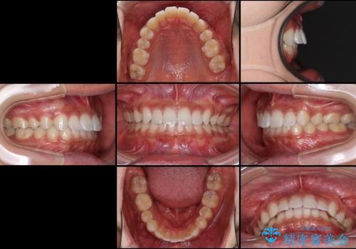 20代男性　出っ歯・ディープバイト　片側抜歯の矯正の治療後