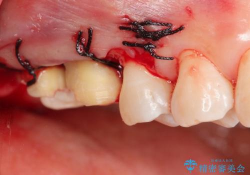 歯冠長延長術を応用した深い虫歯の治療の治療中