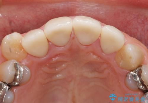 ホワイトニングと前歯のセラミック治療の治療後