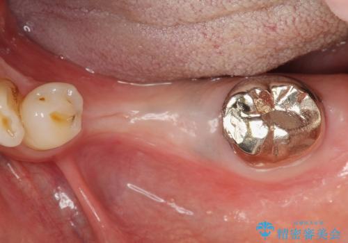 歯牙破折による高度の骨吸収　骨を造成してのインプラント治療の治療前