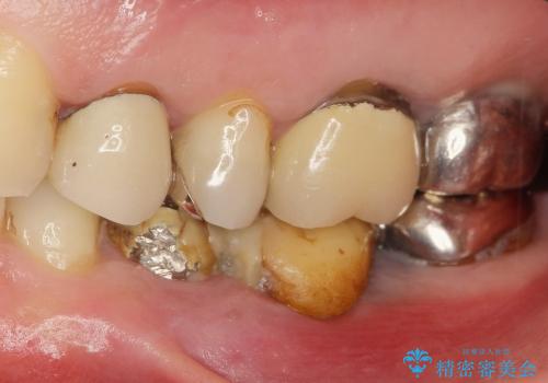 歯牙破折による高度の骨吸収　骨を造成してのインプラント治療の症例 治療前