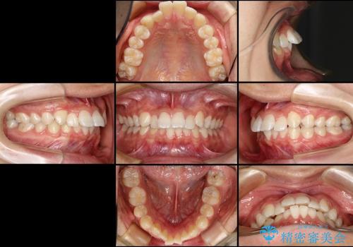 20代男性　出っ歯・ディープバイト　片側抜歯の矯正の治療前