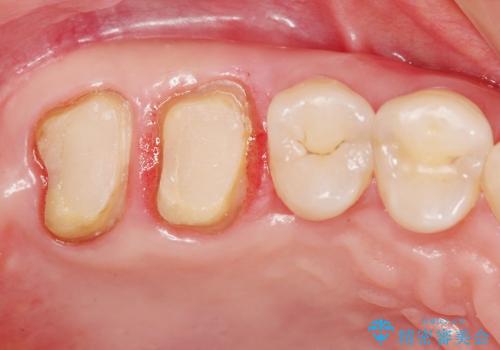 歯冠長延長術を応用した深い虫歯の治療の治療中
