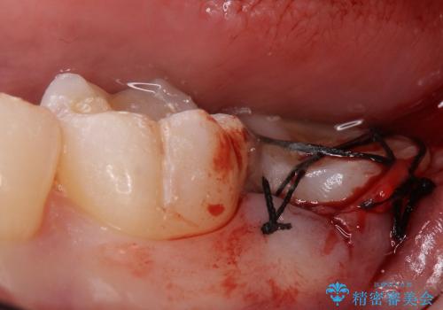 虫歯で抜歯となった左下奥歯に親知らずを自家歯牙移植した症例の治療中