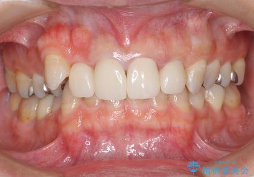 ホワイトニングと前歯のセラミック治療の症例 治療後