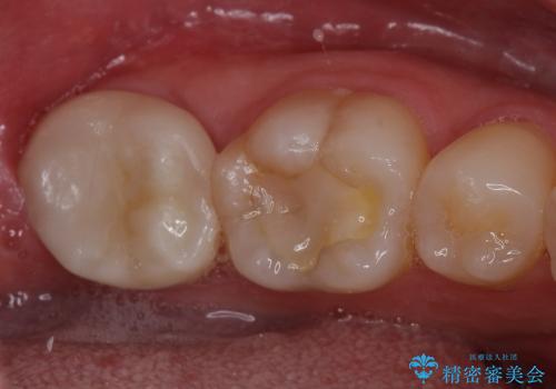 虫歯で抜歯となった左下奥歯に親知らずを自家歯牙移植した症例の症例 治療後