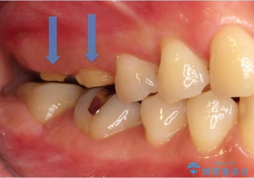 歯冠長延長術を応用した深い虫歯の治療