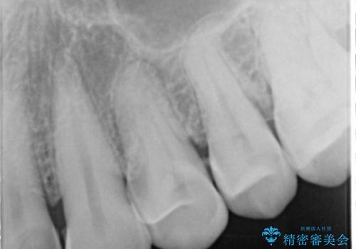 30代女性　前歯のオールセラミック+部分矯正の治療前