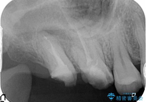 歯冠長延長術を応用した深い虫歯の治療の治療前