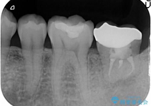 虫歯で抜歯となった左下奥歯に親知らずを自家歯牙移植した症例の治療後