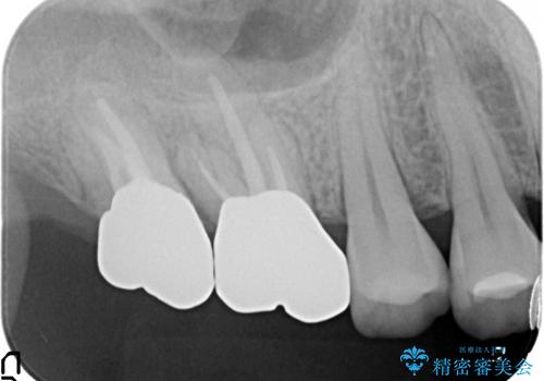 歯冠長延長術を応用した深い虫歯の治療の治療後