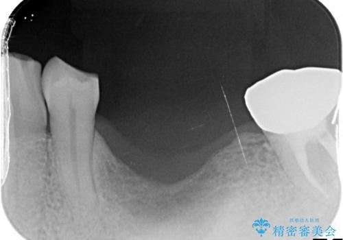 歯牙破折による高度の骨吸収　骨を造成してのインプラント治療の治療前