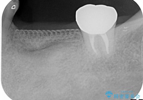 歯牙破折による高度の骨吸収　骨を造成してのインプラント治療の治療中