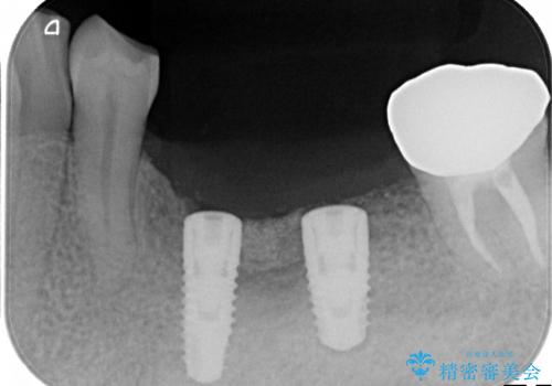 歯牙破折による高度の骨吸収　骨を造成してのインプラント治療の治療中