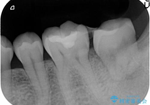 虫歯で抜歯となった左下奥歯に親知らずを自家歯牙移植した症例の治療中