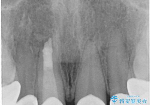 30代女性　前歯のオールセラミック+部分矯正の治療後