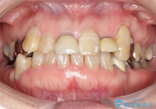 不揃いな差し歯の改善の治療前