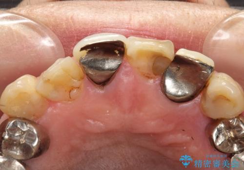 不揃いな差し歯の改善の治療前