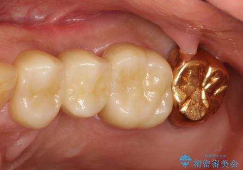 50代男性　抜歯→ブリッジの一例の症例 治療後
