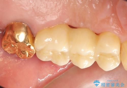 50代男性　抜歯→ブリッジの一例の治療後
