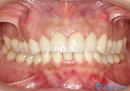 30代女性　前歯のオールセラミック+部分矯正の症例 治療後