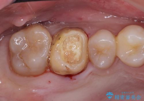 自家歯牙移植(おやしらずの移植)  20代男性の治療前