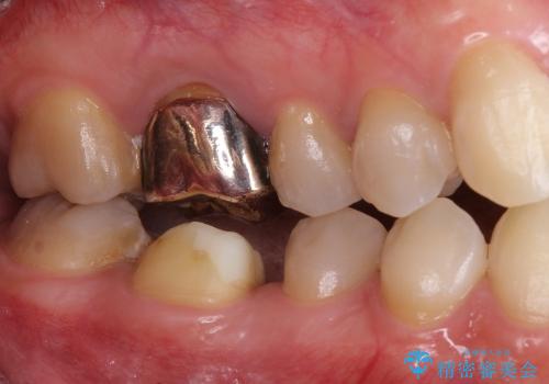 自家歯牙移植(おやしらずの移植)  20代男性の症例 治療前