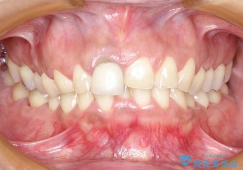 30代女性　前歯のオールセラミック+部分矯正の症例 治療前