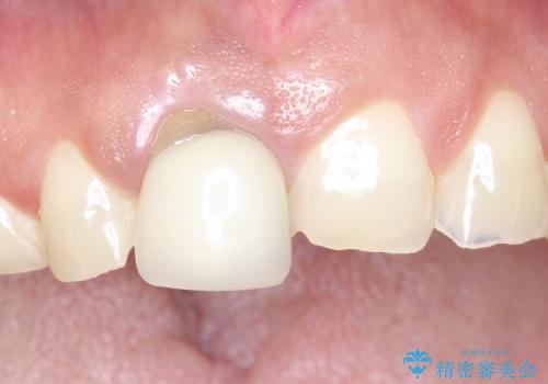 30代女性　前歯のオールセラミック+部分矯正