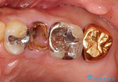 50代男性　抜歯→ブリッジの一例の症例 治療前