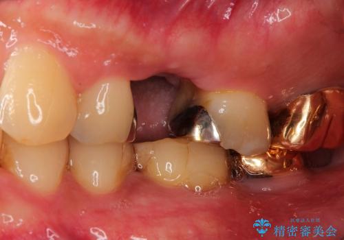 50代男性　抜歯→ブリッジの一例の治療前