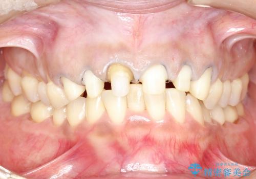 30代女性　前歯のオールセラミック+部分矯正の治療中