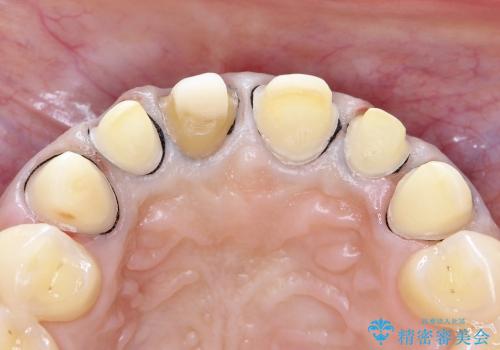 30代女性　前歯のオールセラミック+部分矯正の治療中