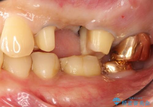 50代男性　抜歯→ブリッジの一例の治療中