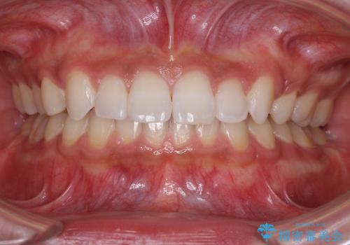 20代男性　出っ歯・ディープバイト　片側抜歯の矯正