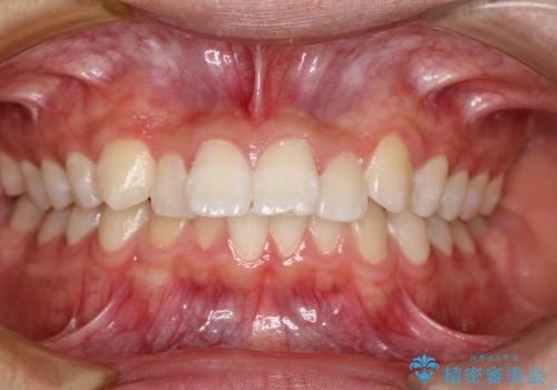 20代男性　出っ歯・ディープバイト　片側抜歯の矯正の症例 治療前