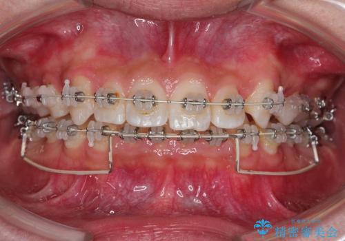20代男性　出っ歯・ディープバイト　片側抜歯の矯正の治療中