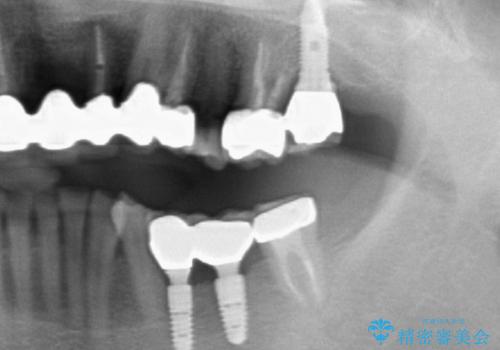 歯牙破折による高度の骨吸収　骨を造成してのインプラント治療の治療後